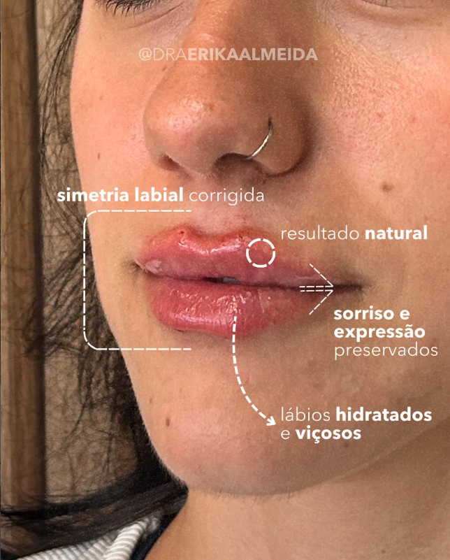 Preenchimento labial - Dra. Erika Almeida